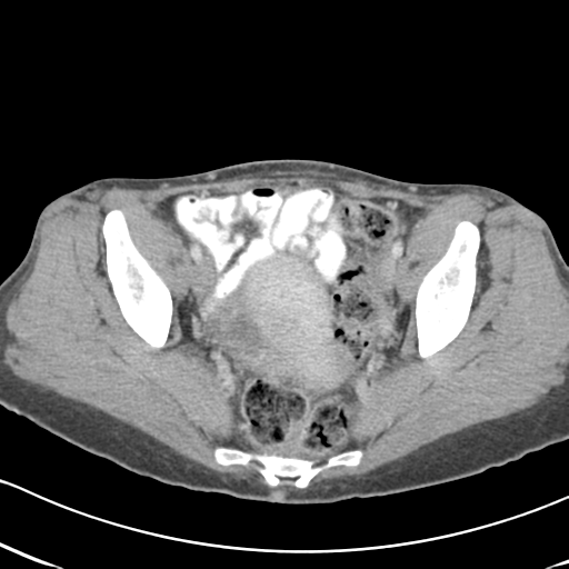Abdominal desmoid tumor (Radiopaedia 41007-43740 Axial C+ portal venous phase 62).png