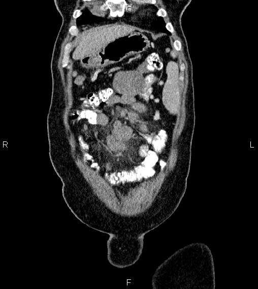 Abdominal lymphoma with sandwich sign (Radiopaedia 84378-99704 Coronal C+ portal venous phase 4).jpg