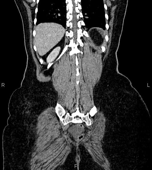 Abdominal lymphoma with sandwich sign (Radiopaedia 84378-99704 Coronal C+ portal venous phase 60).jpg