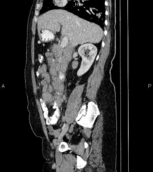 Abdominal lymphoma with sandwich sign (Radiopaedia 84378-99704 Sagittal C+ portal venous phase 30).jpg