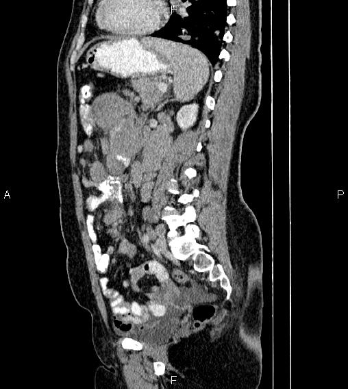 Abdominal lymphoma with sandwich sign (Radiopaedia 84378-99704 Sagittal C+ portal venous phase 57).jpg