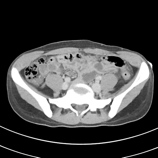File:Abdominal multi-trauma - devascularised kidney and liver, spleen and pancreatic lacerations (Radiopaedia 34984-36486 Axial C+ delayed 56).png