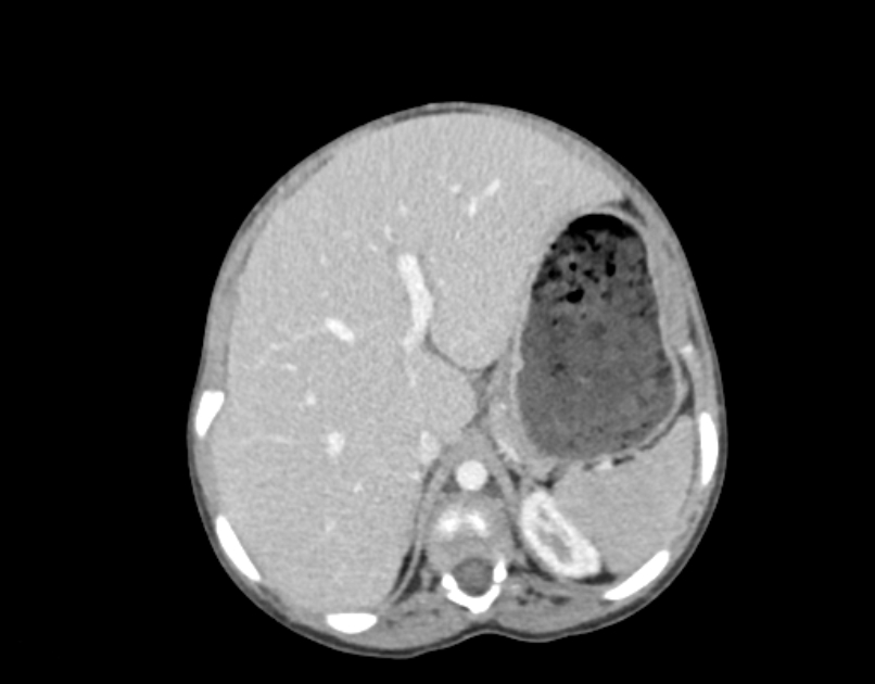 Abdominal premesenteric cystic lymphangioma (Radiopaedia 82995-97350 Axial C+ portal venous phase 11).jpg