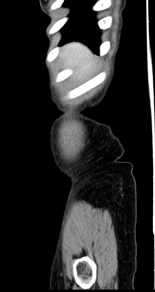 Abdominal wall and retroperitoneal tuberculosis (Radiopaedia 88137-104729 Sagittal C+ portal venous phase 140).jpg