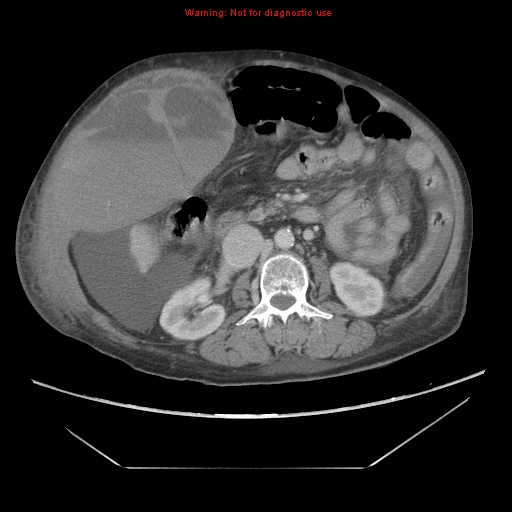 File:Abdominal wall hematoma (Radiopaedia 9427-10112 Axial C+ portal venous phase 48).jpg