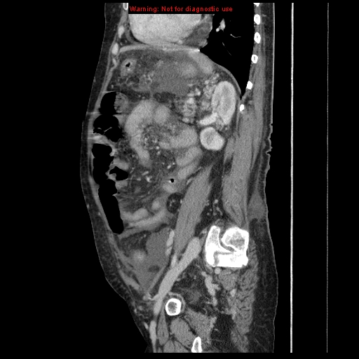 Abdominal wall hematoma (Radiopaedia 9427-10112 Sagittal C+ portal venous phase 36).jpg