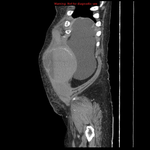 Abdominal wall hematoma (Radiopaedia 9427-10112 Sagittal C+ portal venous phase 96).jpg