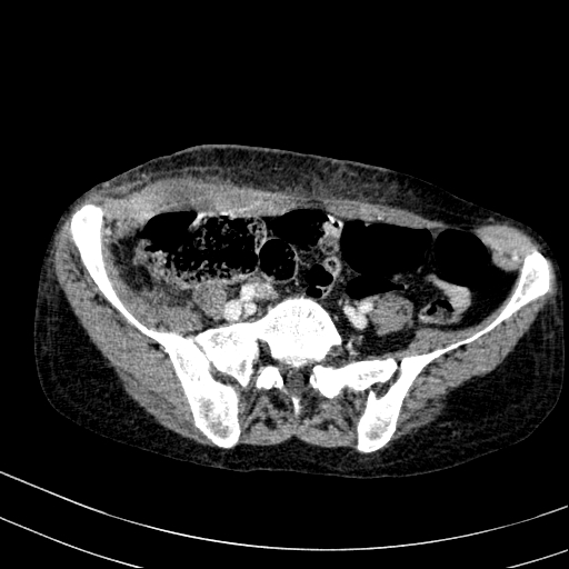 File:Abdominal wall hematoma with active bleeding (Radiopaedia 83915-99117 Axial C+ portal venous phase 93).jpg