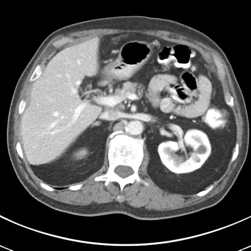 Abdominal wall metastasis from colorectal carcinoma (Radiopaedia 31016-31717 Axial C+ portal venous phase 24).jpg