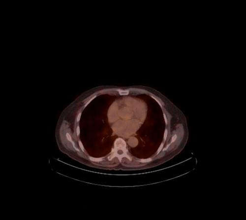 Abdominal wall metastasis from colorectal carcinoma (Radiopaedia 31016-31719 C 103).jpg