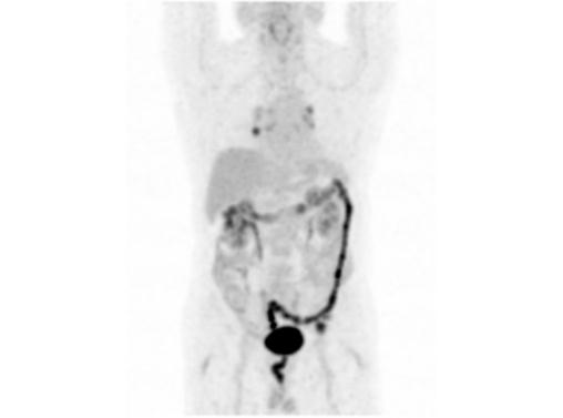 File:Abdominal wall metastasis from colorectal carcinoma (Radiopaedia 31016-31719 Rotational MIP 1).jpg