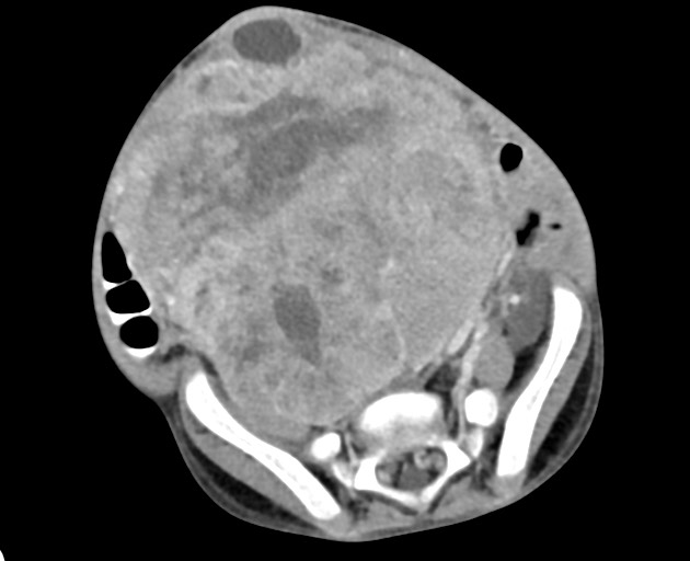 Abdominopelvic rhabdomyosarcoma (Radiopaedia 78356-90984 Axial C+ portal venous phase 121).jpg