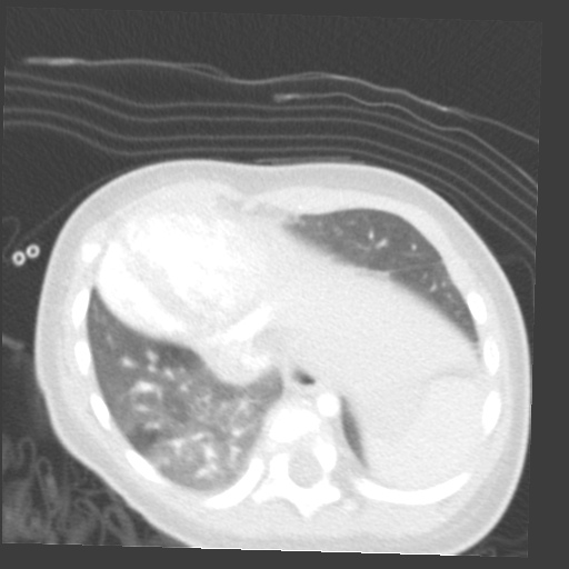 File:Aberrant left pulmonary artery (pulmonary sling) (Radiopaedia 42323-45435 Axial lung window 30).jpg