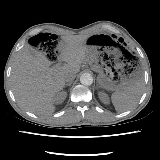 Accessory left horizontal fissure with lingular pneumonia (Radiopaedia 53763-59843 Axial C+ CTPA 87).jpg