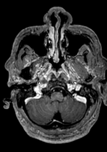 Accessory middle cerebral artery (Radiopaedia 73114-83828 Axial T1 C+ 163).jpg