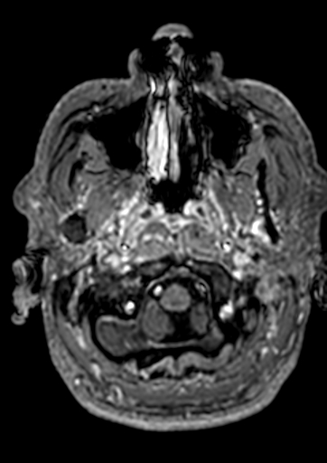 Accessory middle cerebral artery (Radiopaedia 73114-83828 Axial T1 C+ 182).jpg