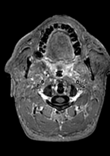 Accessory middle cerebral artery (Radiopaedia 73114-83828 Axial T1 C+ 227).jpg