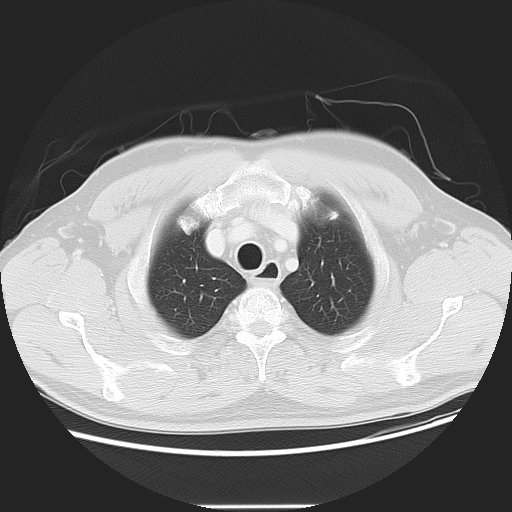 Achalasia (Radiopaedia 8831-9629 Axial lung window 15).jpg