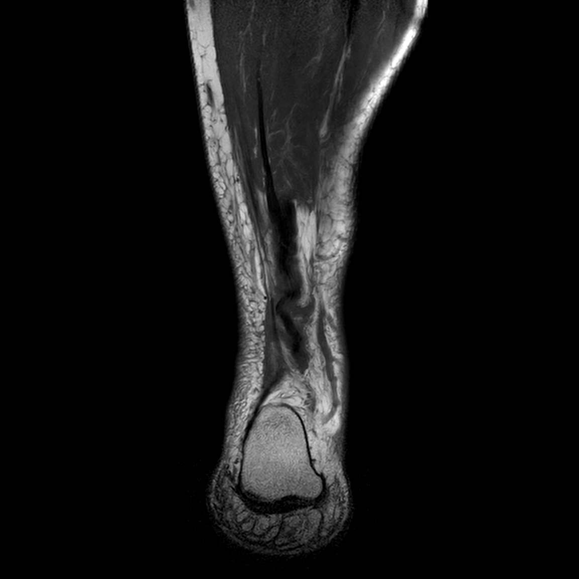 File:Achilles tendon rupture, complete (Radiopaedia 61601-69580 Coronal ...