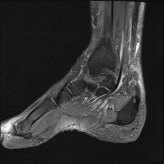 File:Achilles tendon tear (Radiopaedia 77615-89819 Sagittal PD fat sat 7).jpg
