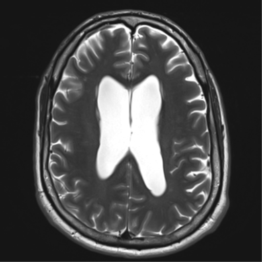 File:Achondroplasia (Radiopaedia 65109-74105 Axial T2 25).png