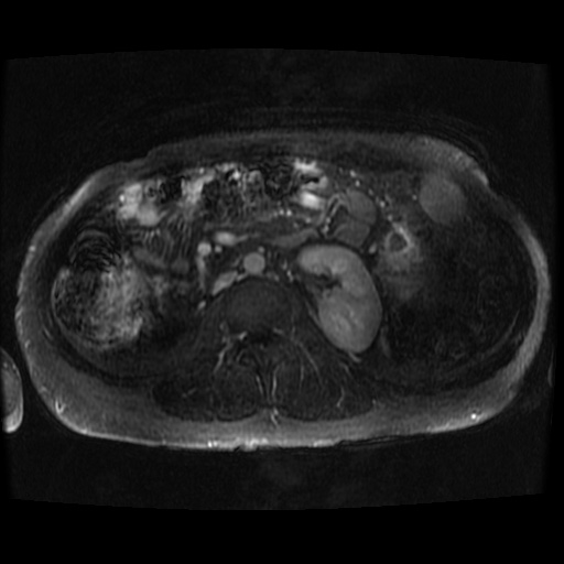 Acinar cell carcinoma of the pancreas (Radiopaedia 75442-86668 Axial T1 C+ fat sat 15).jpg