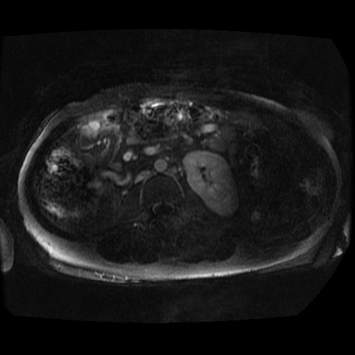 File:Acinar cell carcinoma of the pancreas (Radiopaedia 75442-86668 Axial T1 C+ fat sat 9).jpg