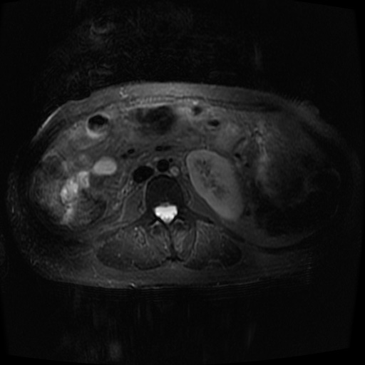 Acinar cell carcinoma of the pancreas (Radiopaedia 75442-86668 Axial T2 fat sat 50).jpg