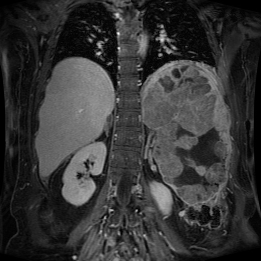 File:Acinar cell carcinoma of the pancreas (Radiopaedia 75442-86668 Coronal T1 C+ fat sat 64).jpg