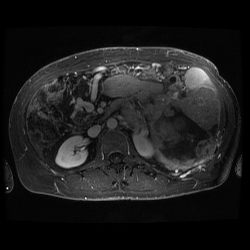 Acinar cell carcinoma of the pancreas (Radiopaedia 75442-86668 D 41).jpg