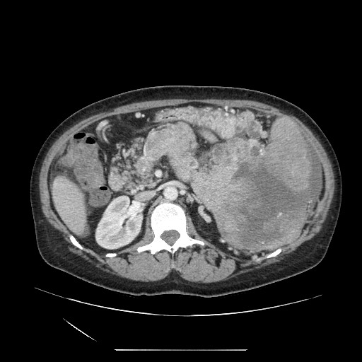 Acinar cell carcinoma of the pancreas (Radiopaedia 75442-86669 Axial C+ portal venous phase 56).jpg