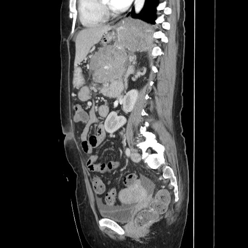 Acinar cell carcinoma of the pancreas (Radiopaedia 75442-86669 Sagittal C+ portal venous phase 111).jpg