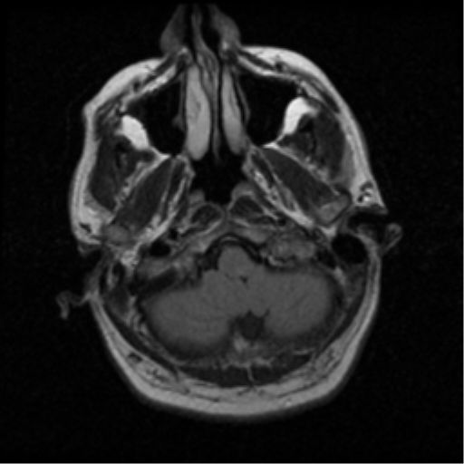 File:Acoustic schwannoma (Radiopaedia 39170-41387 Axial FLAIR 2).png