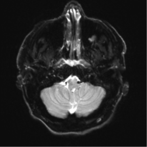 Acoustic schwannoma (Radiopaedia 50846-56358 Axial DWI 4).png