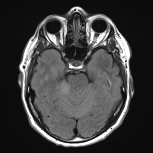 File:Acoustic schwannoma (Radiopaedia 50846-56358 Axial FLAIR 11).png