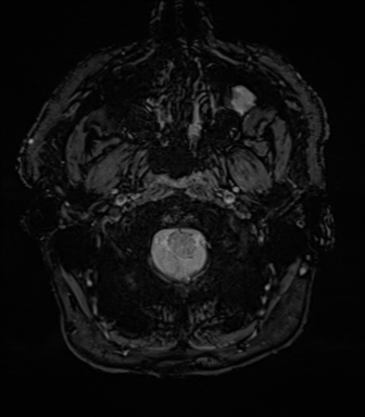 Acoustic schwannoma (Radiopaedia 50846-56358 Axial SWI 6).png