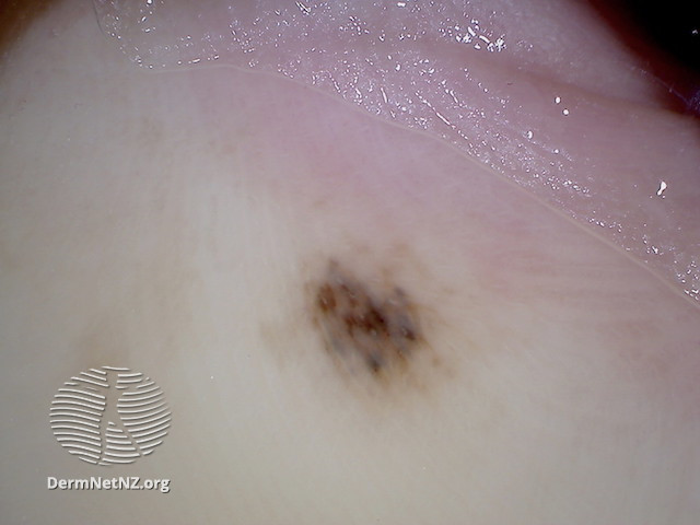 File:Acral lentiginous melanoma 1 dermoscopy (DermNet NZ alm-2-dermoscopy).jpg