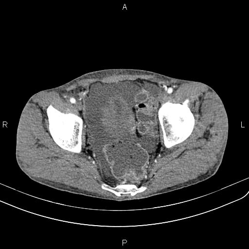 Active crohn disease (Radiopaedia 87133-103397 Axial C+ arterial phase 92).jpg