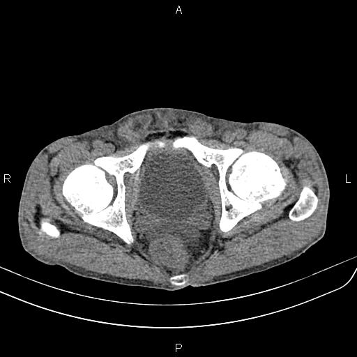 Active crohn disease (Radiopaedia 87133-103397 Axial non-contrast 98).jpg