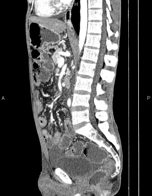 Active crohn disease (Radiopaedia 87133-103397 Sagittal C+ arterial phase 46).jpg