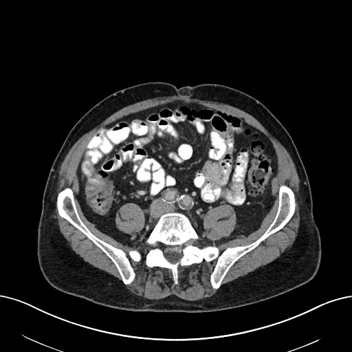 File:Active lower gastrointestinal bleeding - diverticular (Radiopaedia 61203-69106 Axial C+ portal venous phase 83).jpg