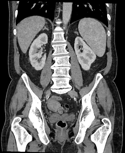 Active lower gastrointestinal bleeding - diverticular (Radiopaedia 61203-69106 Coronal C+ portal venous phase 89).jpg