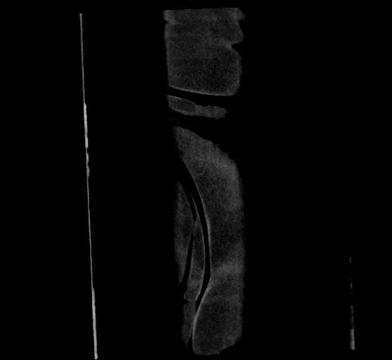 Active renal extravasation with large subcapsular and retroperitoneal hemorrhage (Radiopaedia 60975-68796 Coronal C+ arterial phase 151).jpg