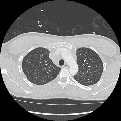 File:Active right ventricular cardiac sarcoidosis (Radiopaedia 55596-62101 Axial lung window 7).jpg