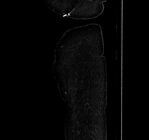 Acute appendicitis, heterotaxy syndrome (Radiopaedia 66884-76202 Sagittal C+ portal venous phase 128).jpg