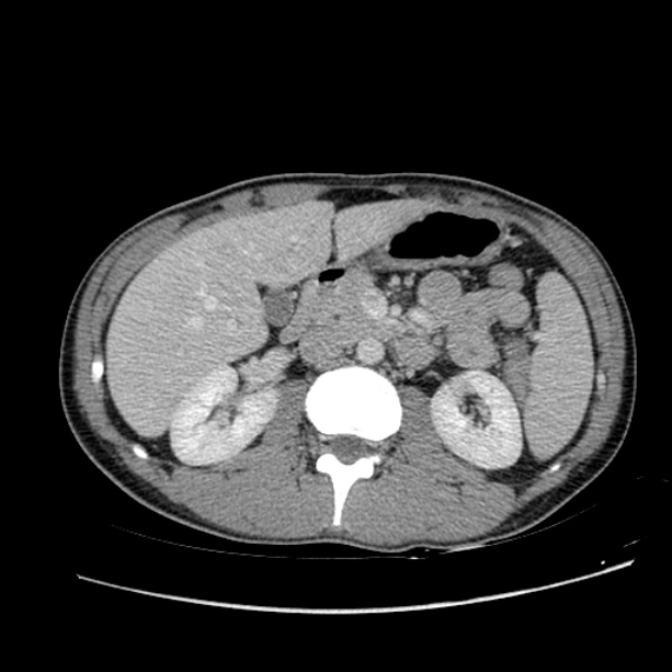 Acute appendicitis (Radiopaedia 27049-27227 Axial C+ portal venous phase 27).jpg