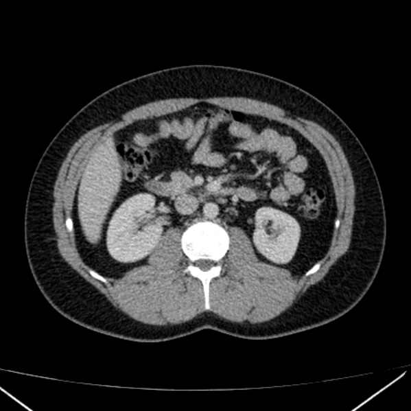 File:Acute appendicitis (Radiopaedia 38255-40270 Axial C+ portal venous phase 44).jpg