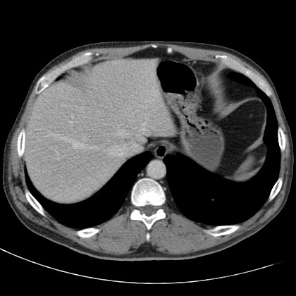 Acute appendicitis (Radiopaedia 66513-75790 Axial C+ portal venous phase 1).jpg