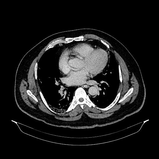 Acute appendicitis (Radiopaedia 79950-93224 Axial C+ portal venous phase 2).jpg