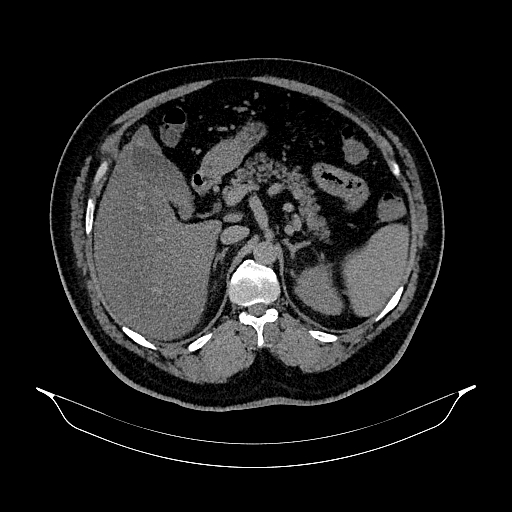 Acute appendicitis (Radiopaedia 79950-93224 Axial non-contrast 32).jpg